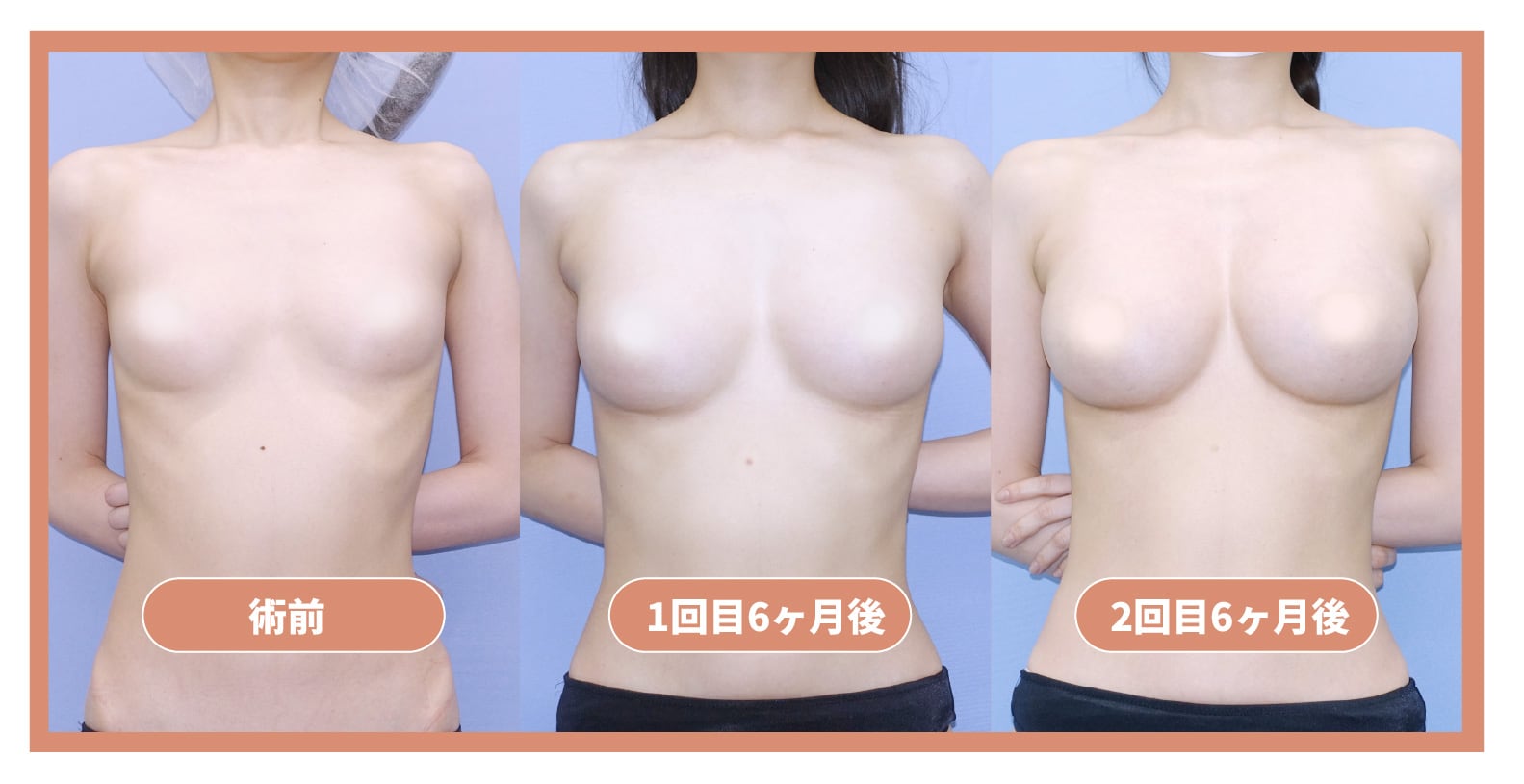脂肪だけで大きくするなら《２次豊胸》