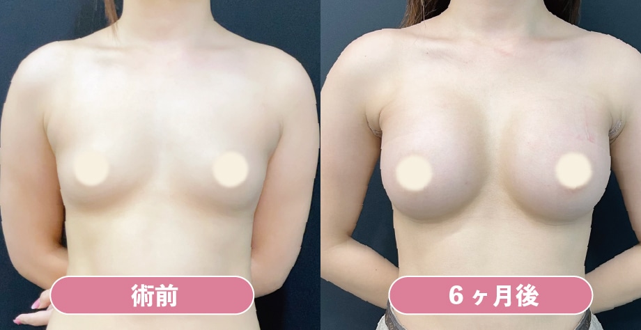 《シリコンバッグ豊胸》MotivaErgonomix2(両側295cc)の症例