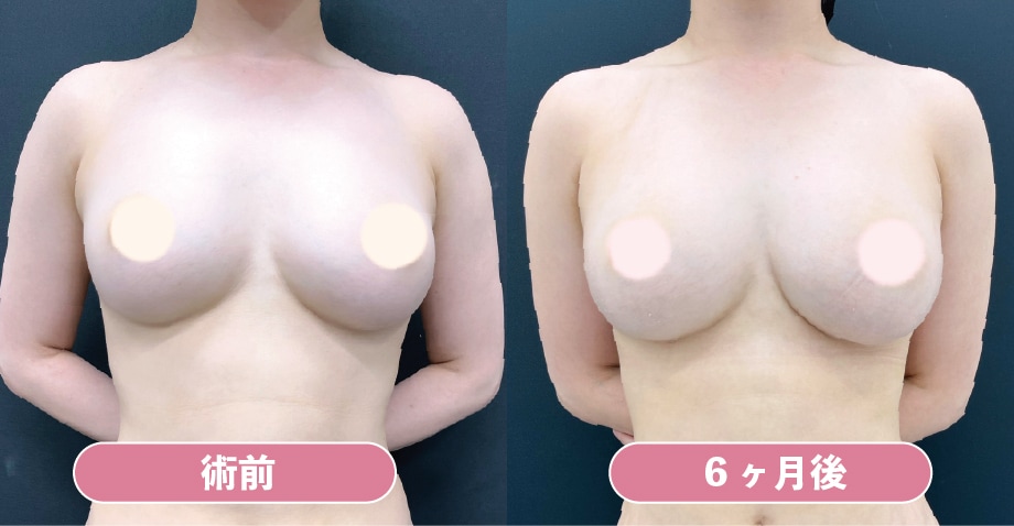 《脂肪豊胸》アキーセル併用コンデンスリッチ豊胸