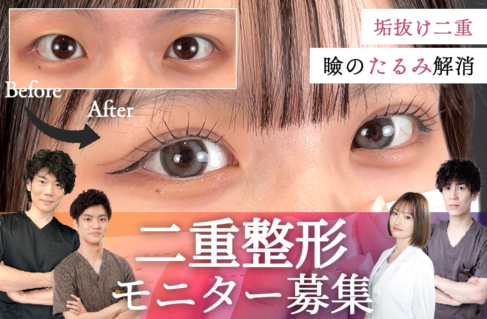 二重のプロフェッショナルドクター達による★二重モニター募集