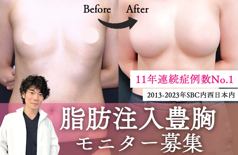 圧倒的症例数の横谷医師による★脂肪注入豊胸モニター募集