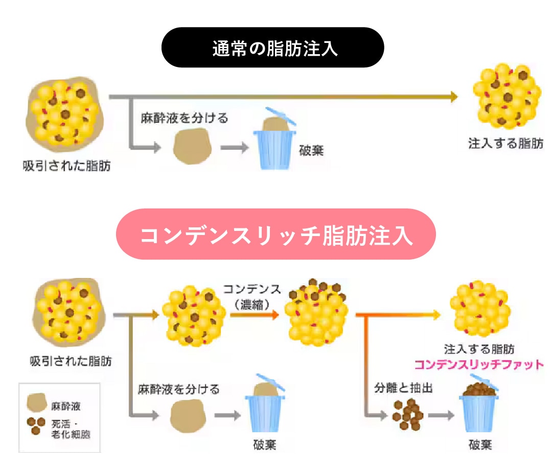 コンデンスリッチ豊胸とは