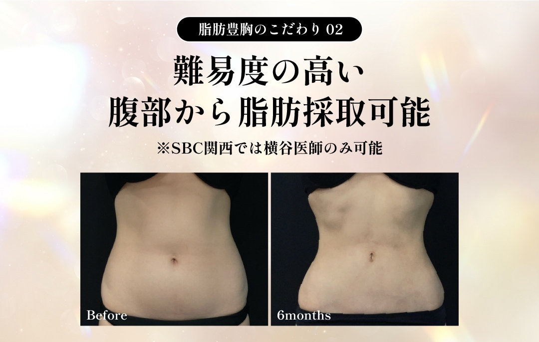お腹からの脂肪採取可能