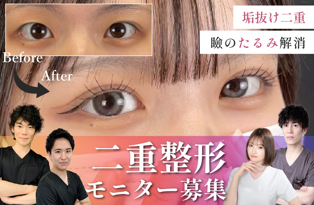 【症例モニター募集】二重整形を大阪梅田でお得にするなら?【部分モニター】