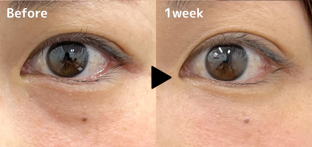 ベビーコラーゲンでクマ解消！