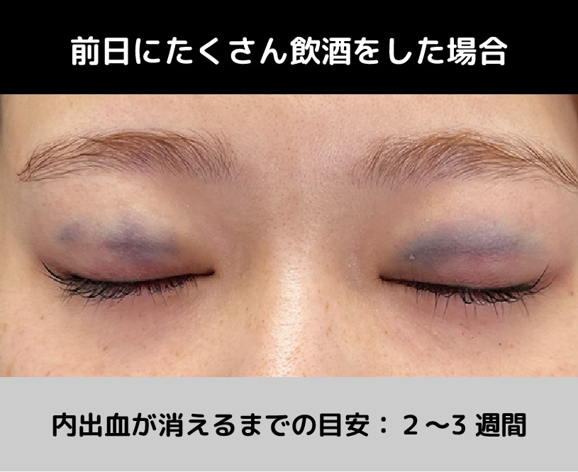 前日にたくさん飲酒をした場合の内出血