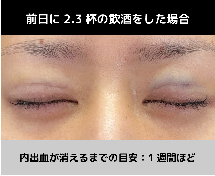 前日に2.3杯の飲酒をした場合の内出血