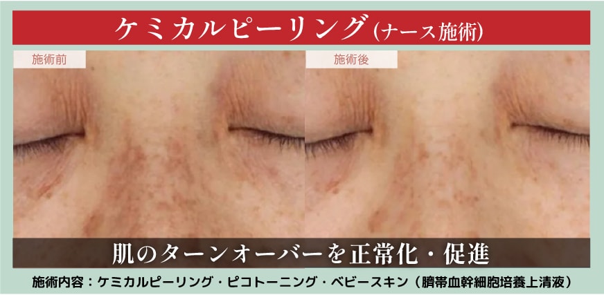 ①肌質改善基礎治療★肌悩みトータル改善する 