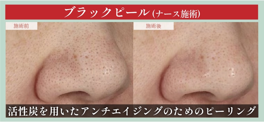 ②活性炭を用いたアンチエイジングケア  