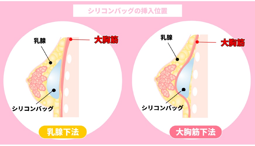シリコンバッグの挿入位置