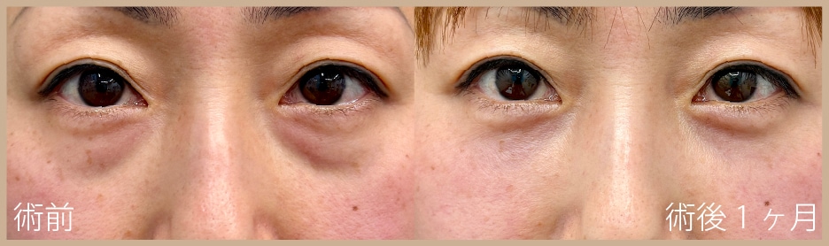 【40代】裏ハムラ