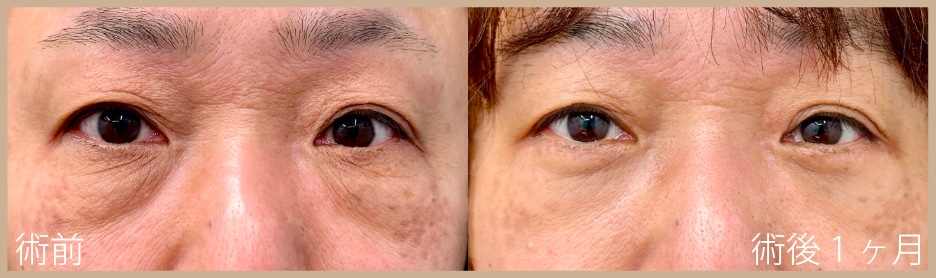 【50代】切開ハムラ