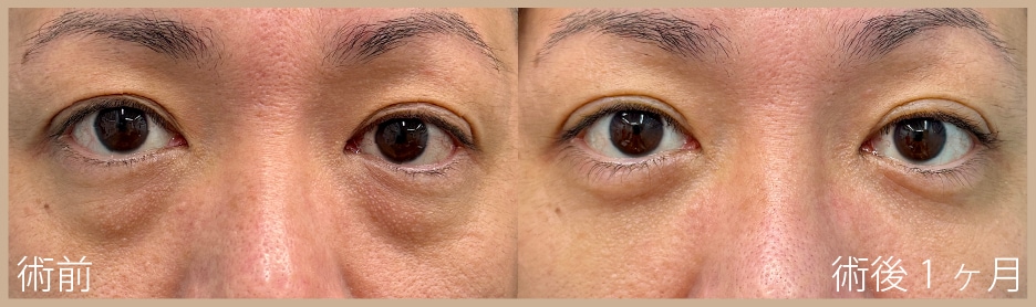 【40代男性】裏ハムラ