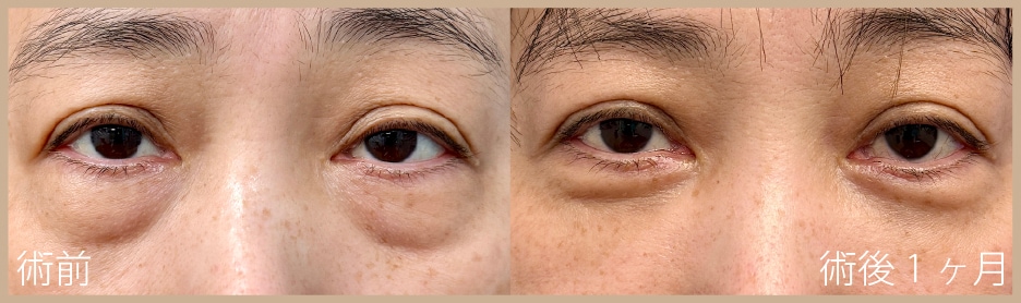 【50代】裏ハムラ