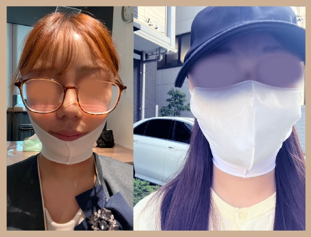 ダウンタイム（腫れ・内出血）の生活への影響