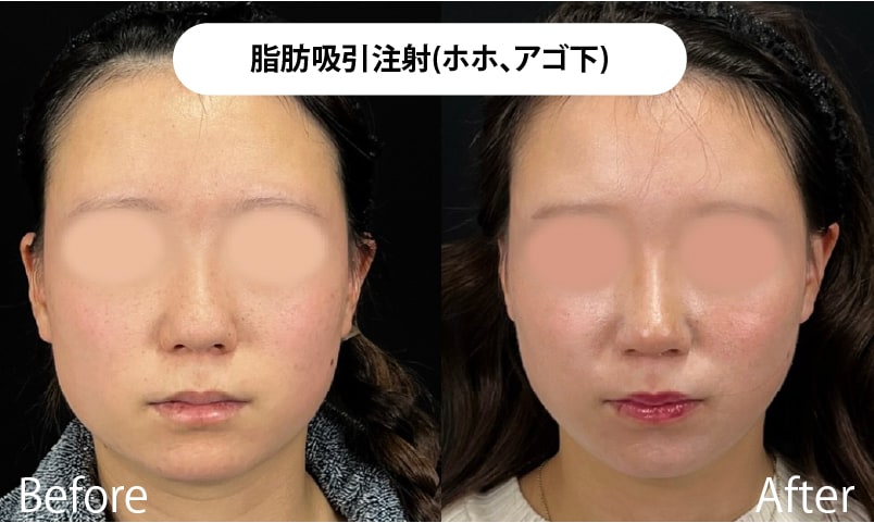 【ダウンタイムを最小限にしたい方】切らない小顔術「脂肪吸引注射」