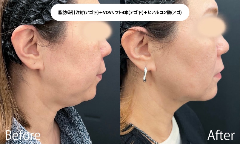 【たるみリスクを減らしたい方】脂肪吸引×糸リフトで効果UP！