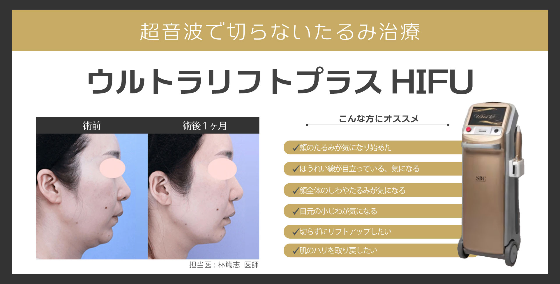 ウルトラリフトプラスHIFU