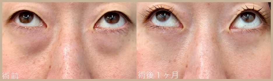 なだらかな頬のラインが形成できる