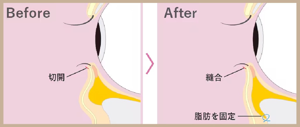 切開ハムラ（表ハムラ）：目の下のたるみもまとめて解消したい方