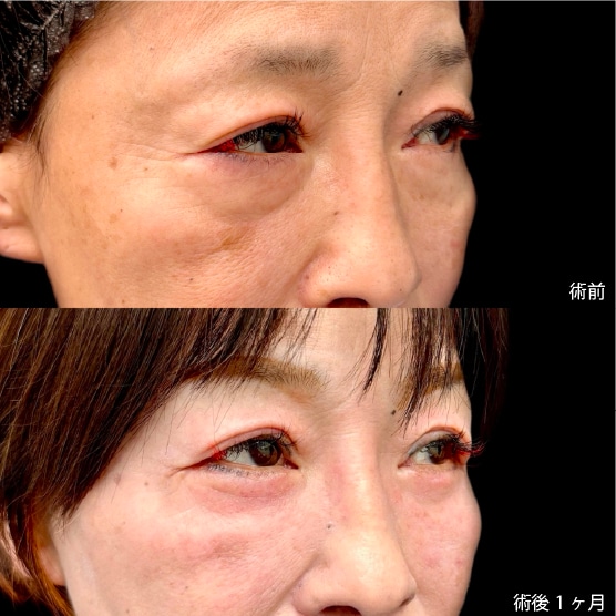 60代：切開ハムラ