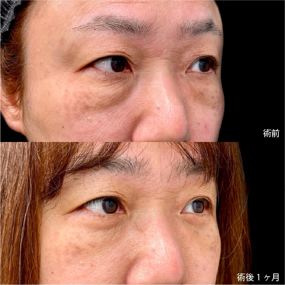 50代：切開ハムラ