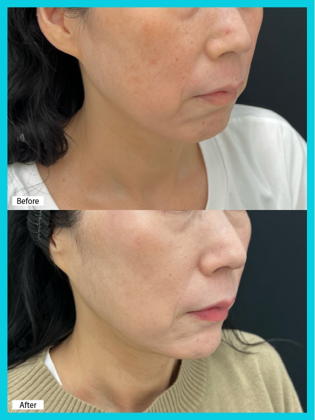 50代×VOVリフト10本