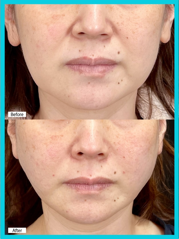 50代×シークレットリフト4本＋VOVリフト8本