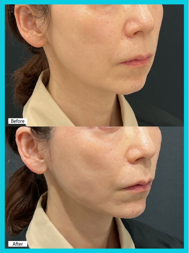 50代×シークレットリフト8本＋VOVリフト4本の症例