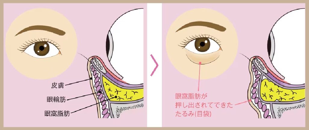 脱脂：目の下の膨らみだけが気になる