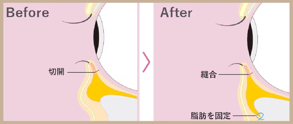 裏ハムラ：目の下の凹みも影も直したい方