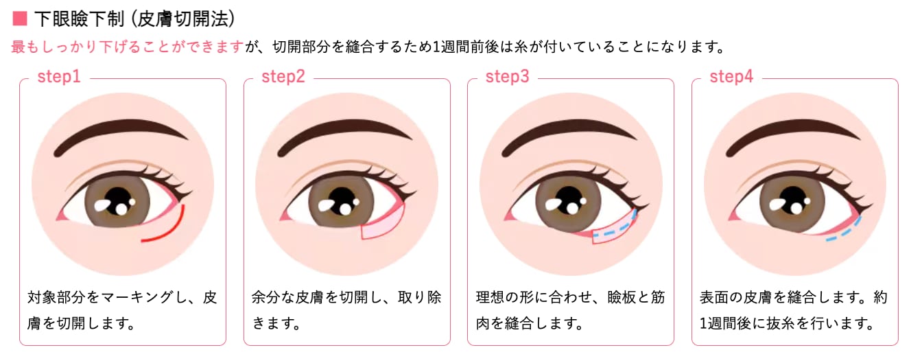 タレ目形成で失敗したくない方へ】グラマラスラインの裏側とダウン 