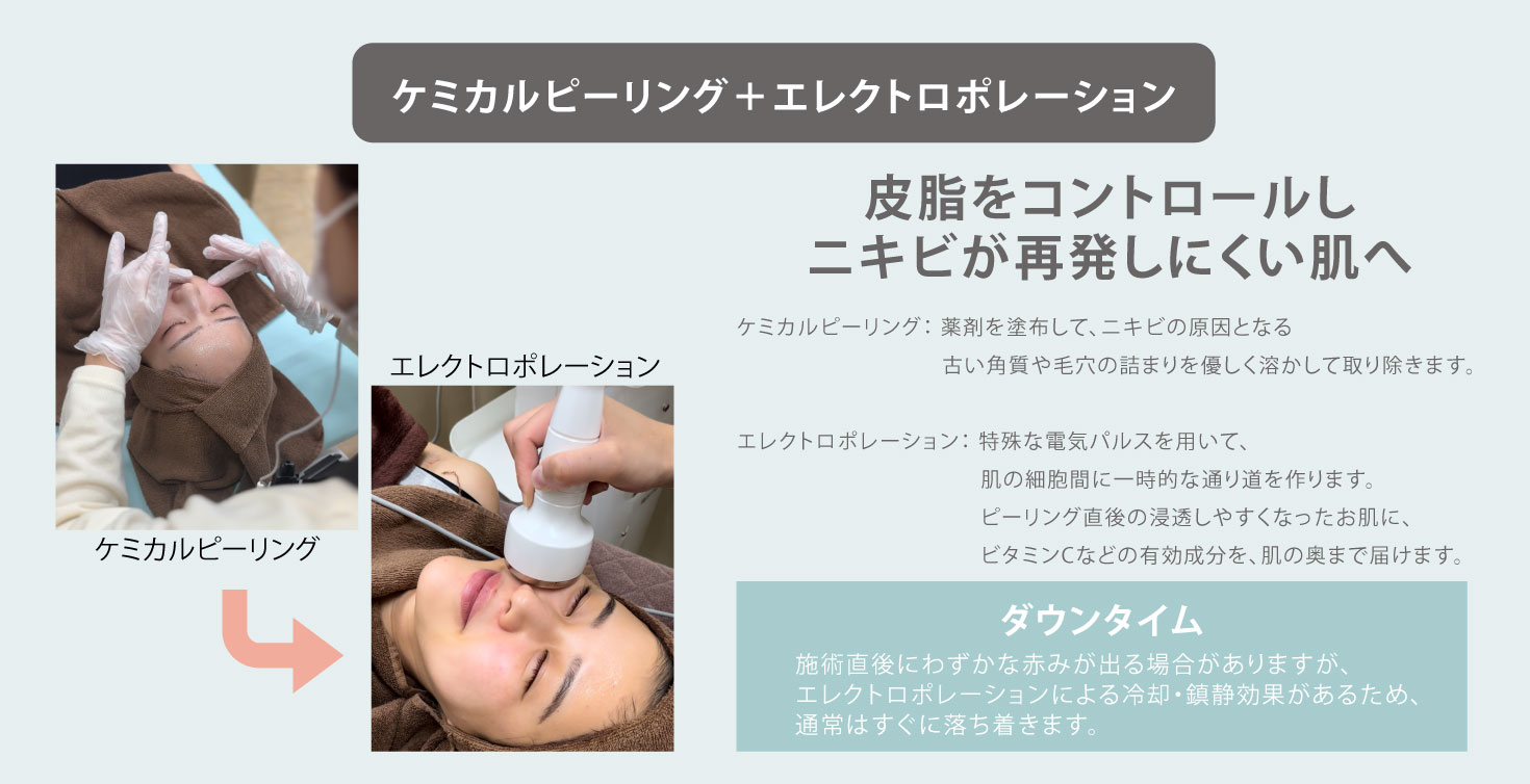 白ニキビ・黒ニキビには“ケミカルピーリング＋エレクトロポレーション”