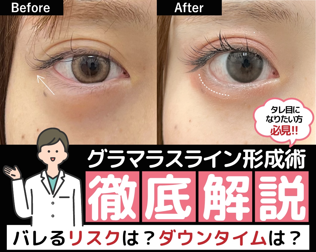 【タレ目形成で失敗したくない方へ】グラマラスラインの裏側とダウンタイム、バレるリスクを徹底解説！
