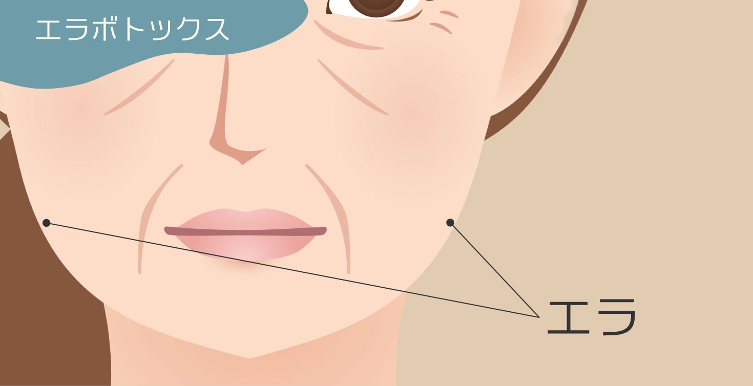 小顔になりたい方へ【エラボトックス】