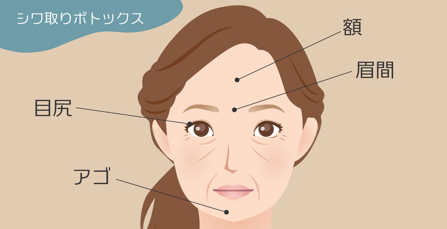 表情筋によるシワを予防したい方へ【額・眉間・目尻・アゴ】<br />
