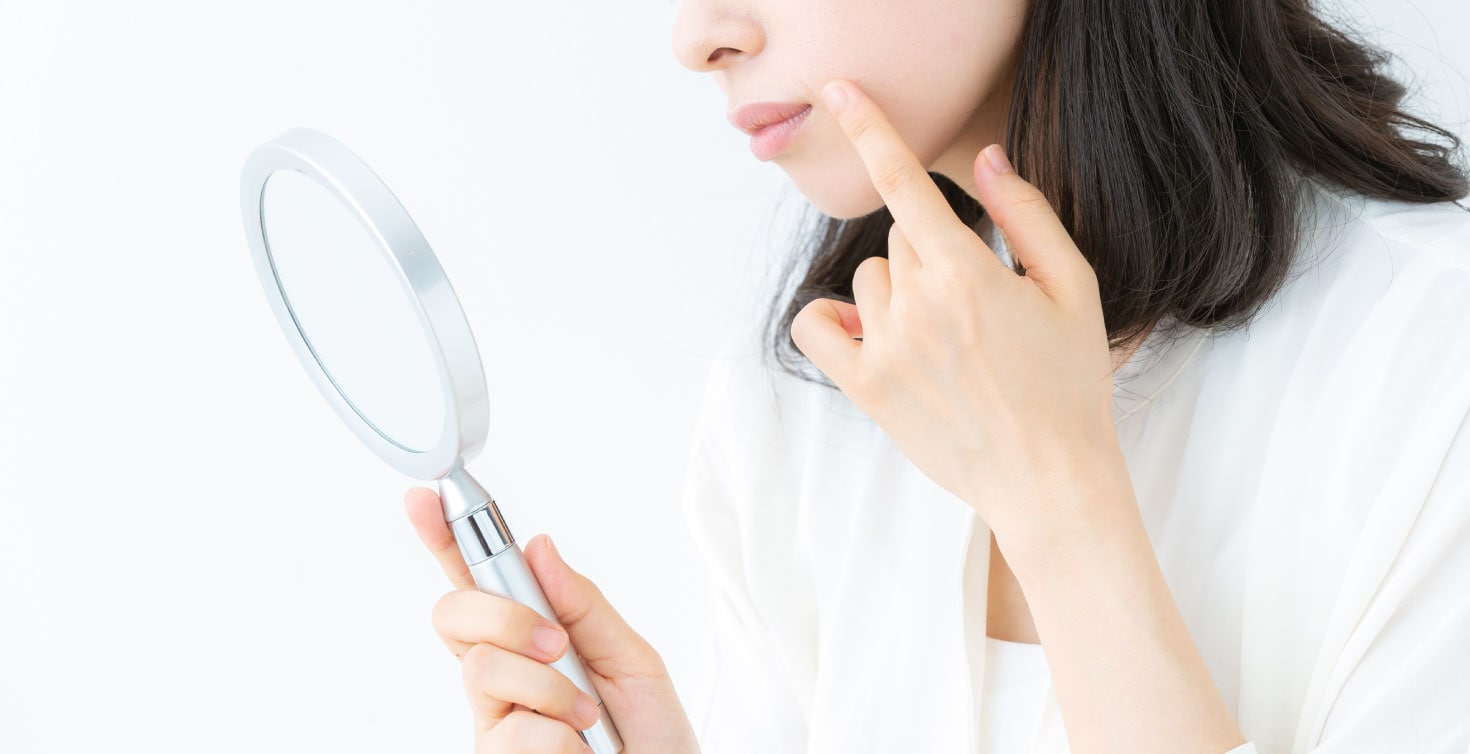 保険診療で治らなかったニキビ<br />
