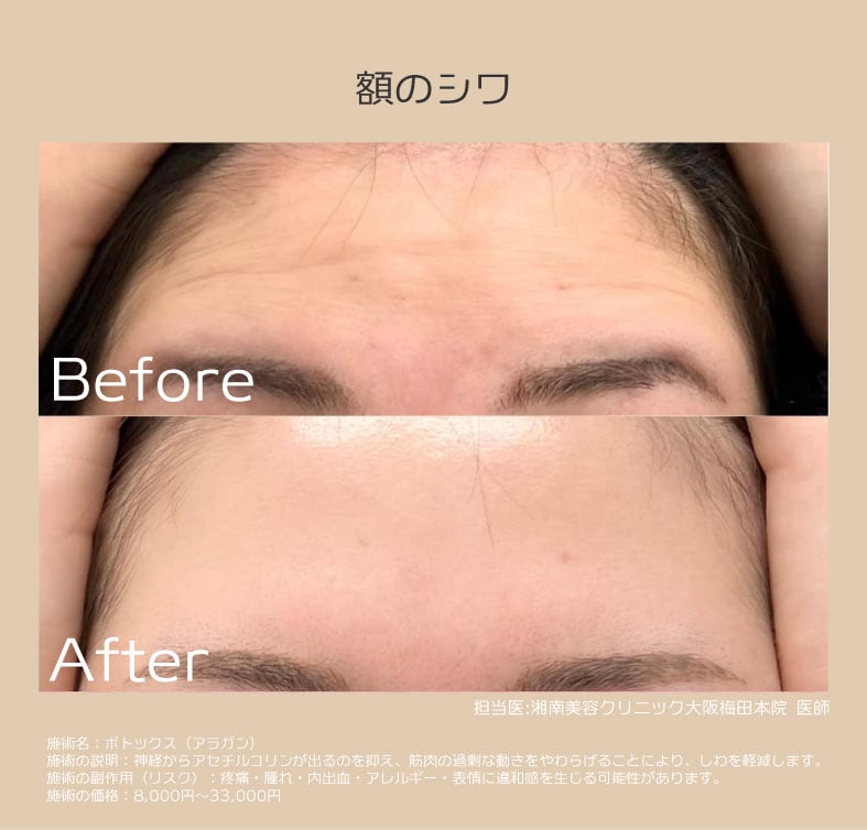 額：表情のクセや加齢のシワでお悩みの方に