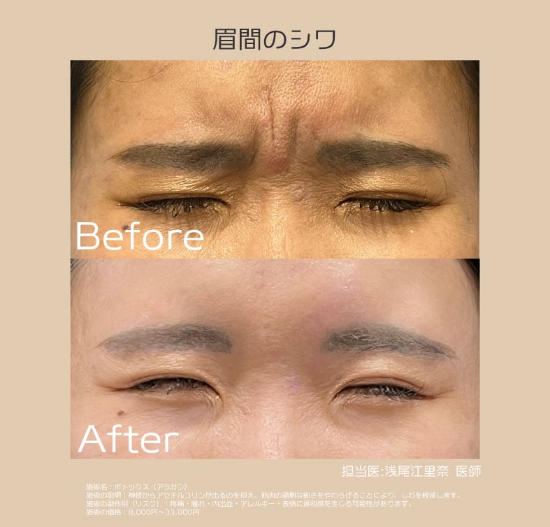 眉間：クセで眉間にシワを寄せてしまう方に