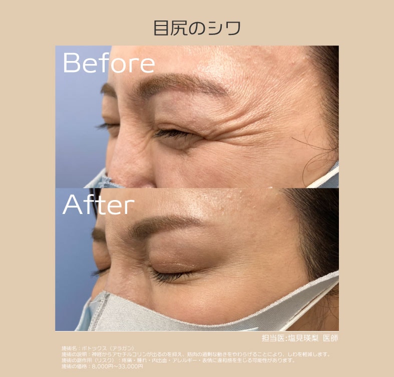 目尻：笑った時の表情ジワでお悩みの方に