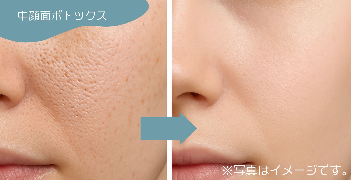 毛穴の開きには中顔面ボトックス（マイクロボトックス）<br />
