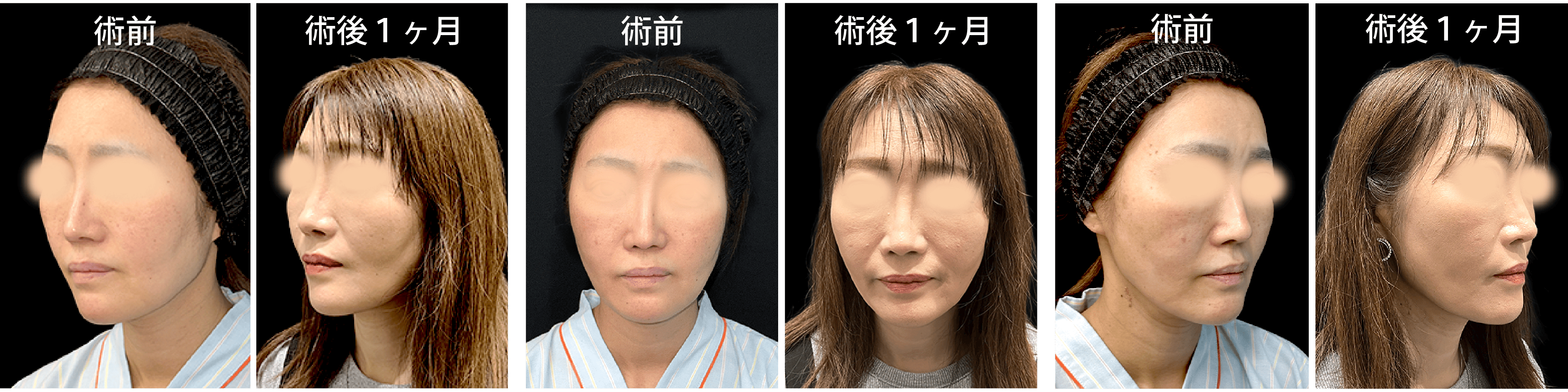 脂肪注入 × 糸リフト