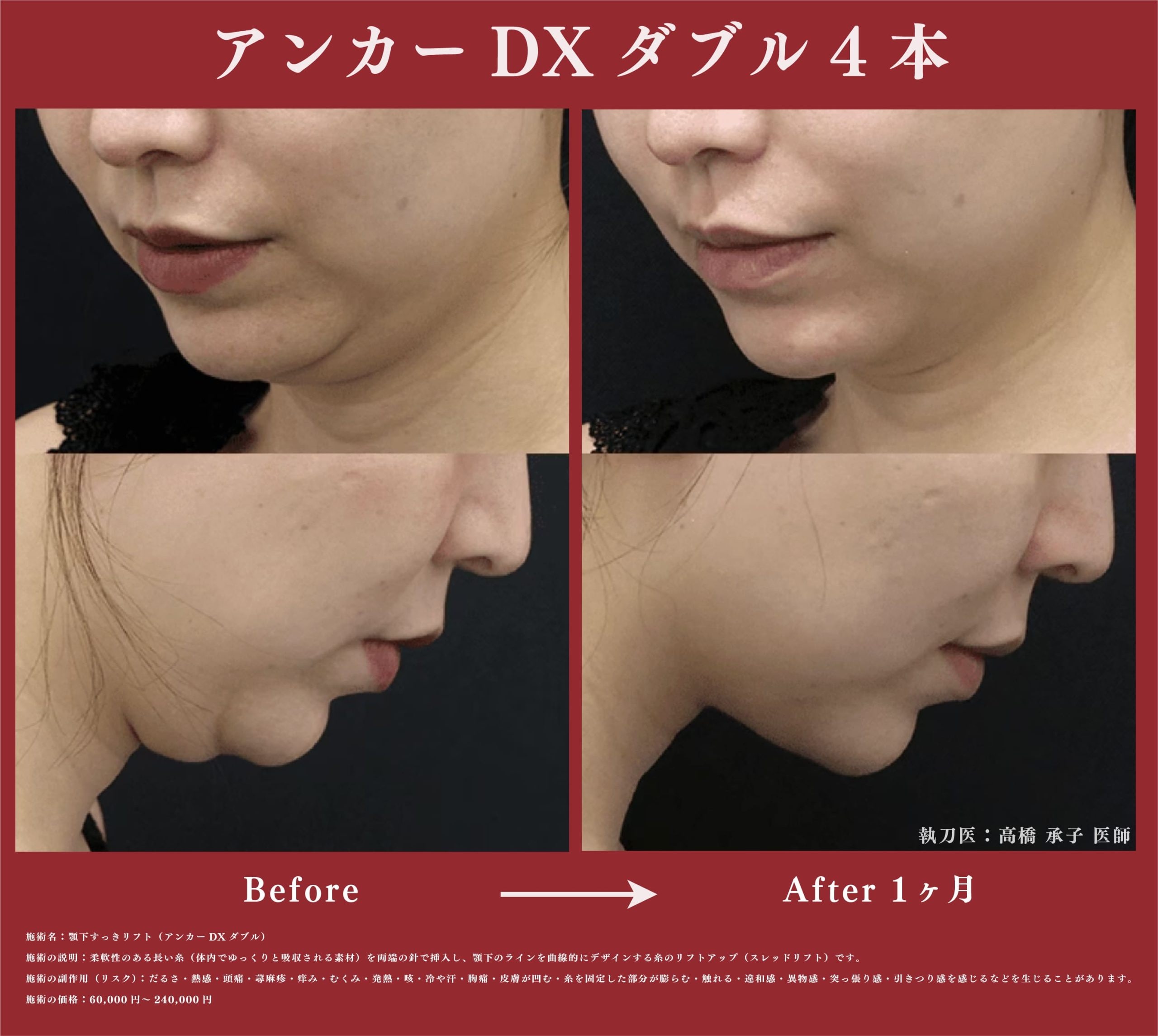 【こんなに変わる😳✨】顎下すっきリフト（アンカーDXダブル）‼️