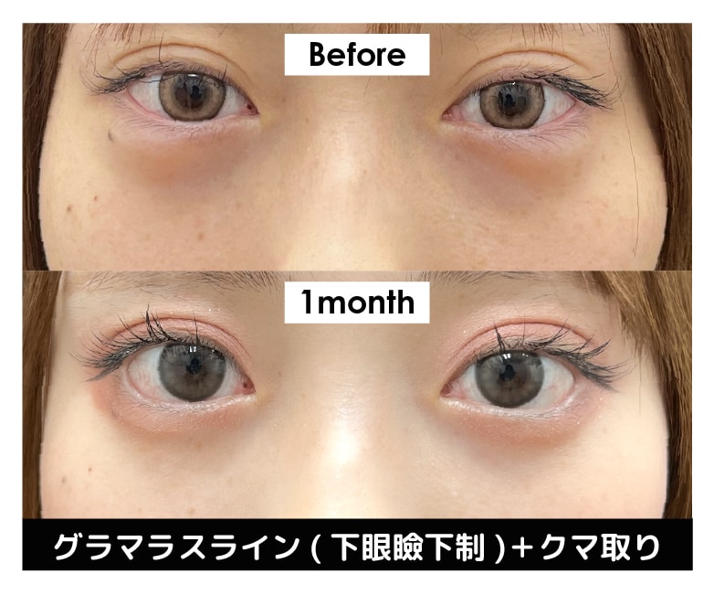 「クマ取り」との同時施術による相乗効果