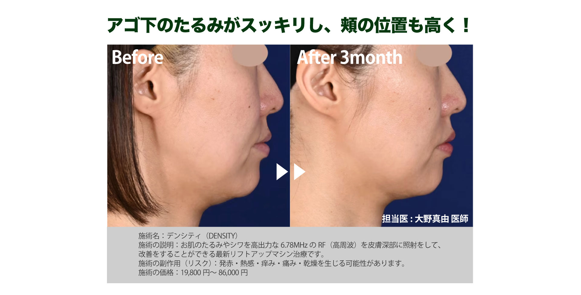 ３００ショットがオススメです✨