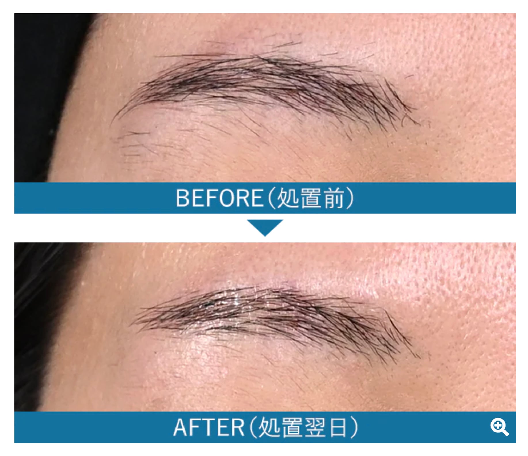 男女ともに大人気✨【眉毛の症例②】