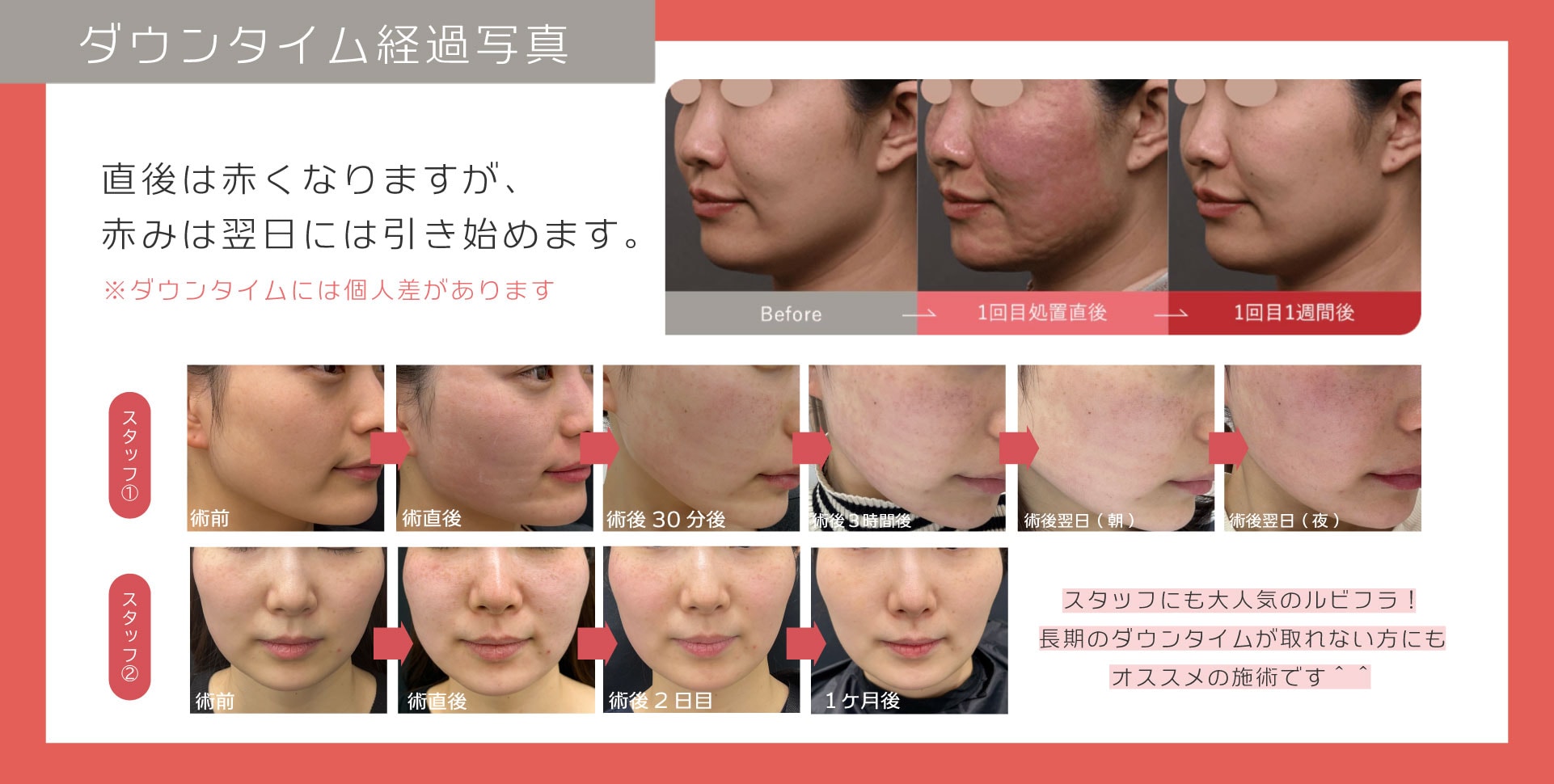 経過とダウンタイム