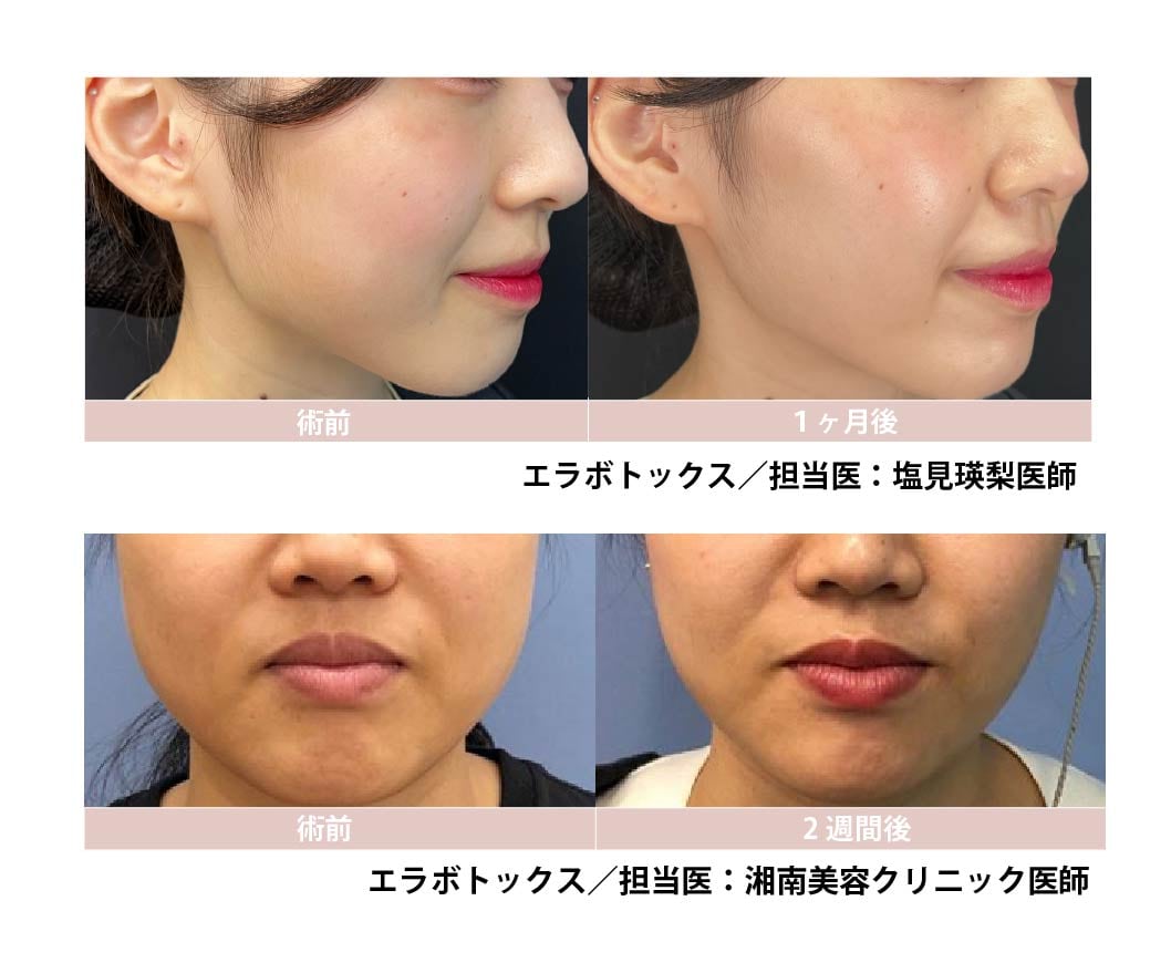 エラボトックス注射で小顔効果抜群！<br />

