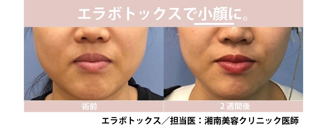 エラボトックスで小顔に
