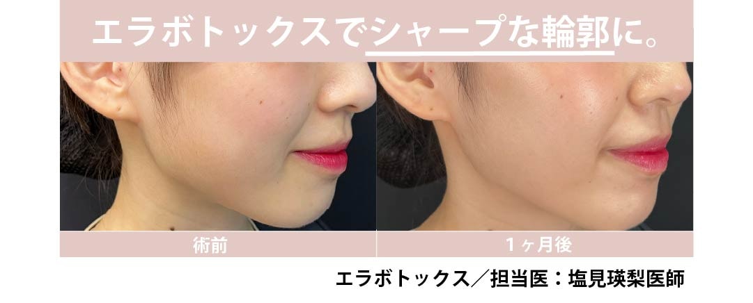 エラボトックスでシャープな輪郭に